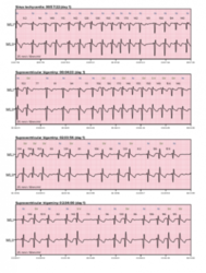 Holter EKG CORTRIUM C3 (Holter ecg)