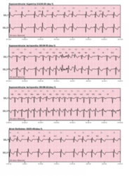 Holter EKG CORTRIUM C3 (Holter ecg)