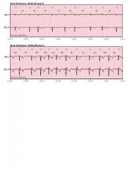 Holter EKG CORTRIUM C3 (Holter ecg)